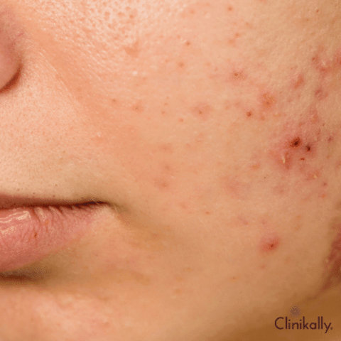 Fungal Acne