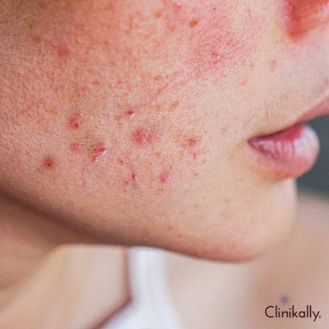 benzoyl peroxide for acne