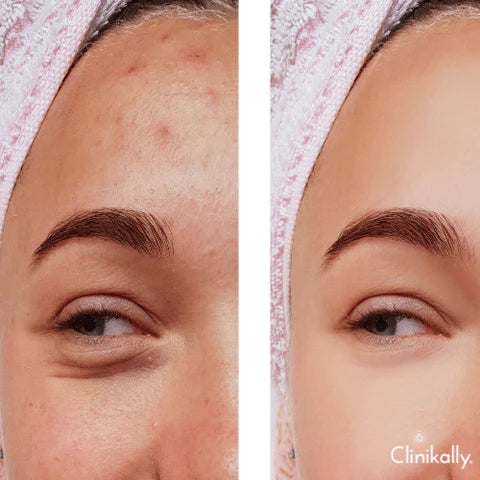 Using Salicylic acid for acne treatment