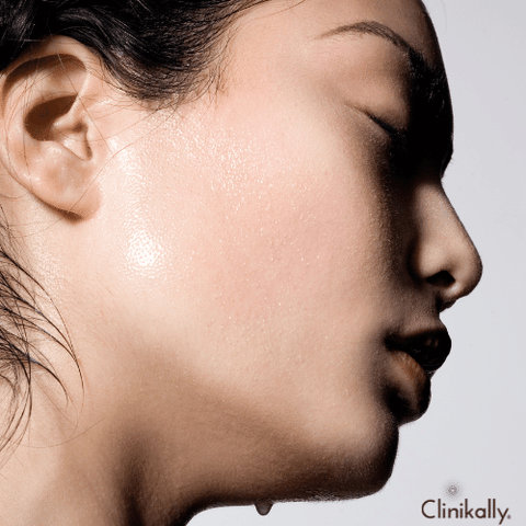 Fungal Acne