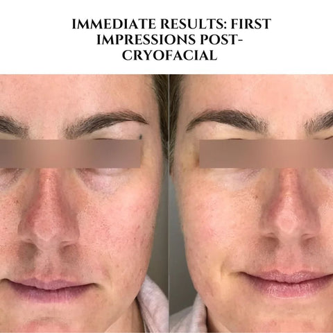 Immediate Results: First Impressions Post-Cryofacial