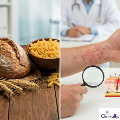 Affected arm with skin condition