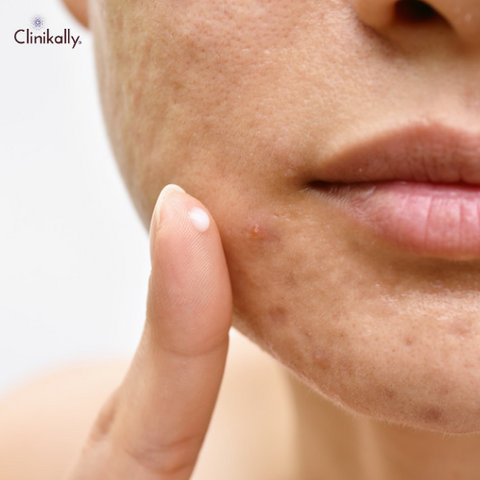 arnica for skin