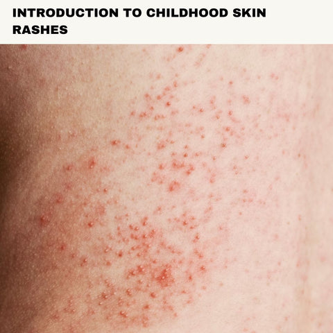 Introduction to Childhood Skin Rashes