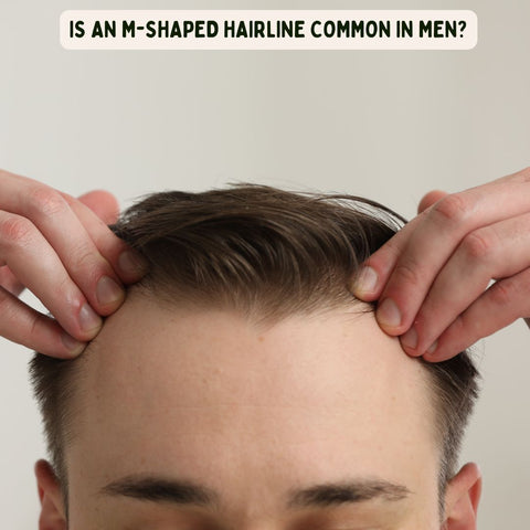 Is an M-Shaped Hairline Common in Men?
