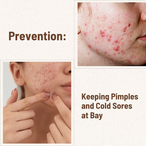 Prevention: Keeping Pimples and Cold Sores at Bay