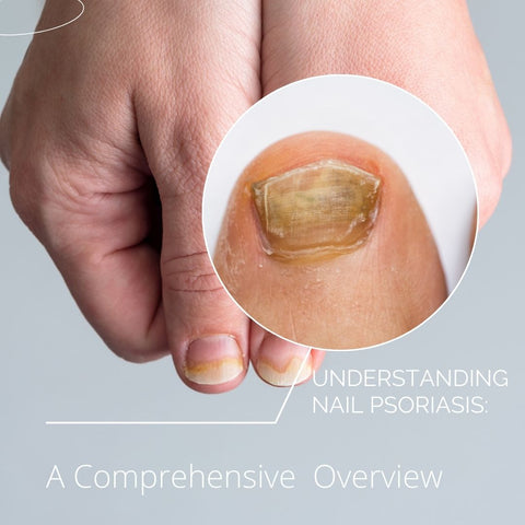 Understanding Nail Psoriasis: A Comprehensive   Overview