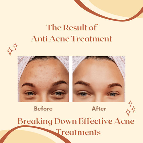Breaking Down Effective Acne Treatments