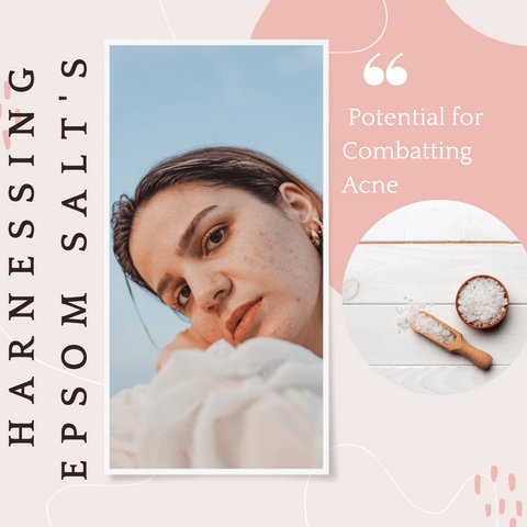 Harnessing Epsom Salt's Potential for Combatting Acne