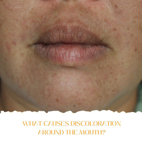 What Causes Discoloration Around the Mouth?