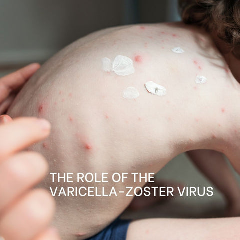The Role of the Varicella-Zoster Virus