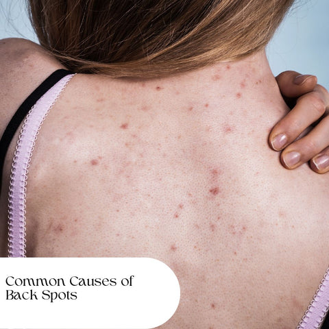 Common Causes of Back Spots