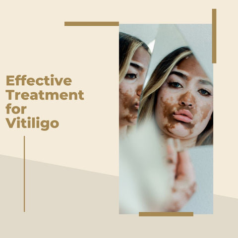 Effective Treatment for Vitiligo