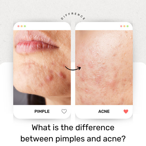 What is the difference between pimples and acne?