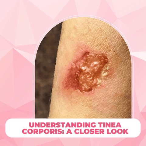 Understanding Tinea Corporis: A Closer Look