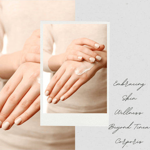 Embracing Skin Wellness: Beyond Tinea Corporis