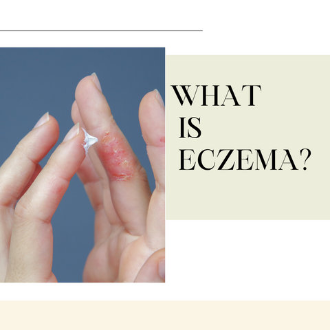 What is eczema?