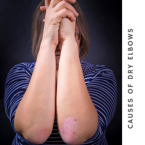 Causes of dry elbows