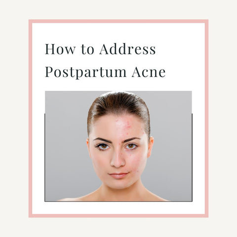 How to Address Postpartum Acne
