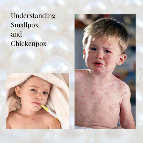 Understanding Smallpox and Chickenpox