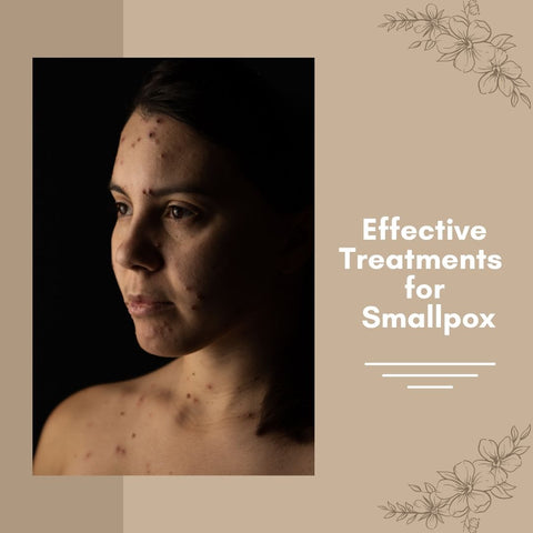 Effective Treatments for Smallpox