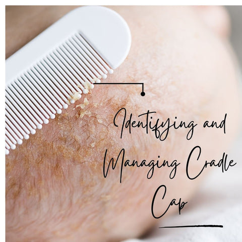 Identifying and Managing Cradle Cap