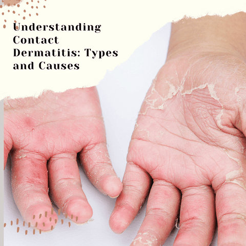 Understanding Contact Dermatitis: Types and Causes