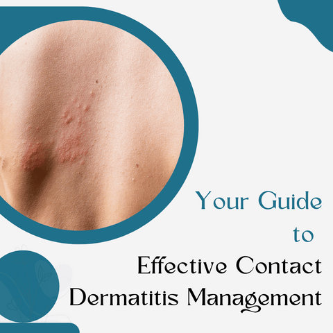 Your Guide to Effective Contact Dermatitis Management