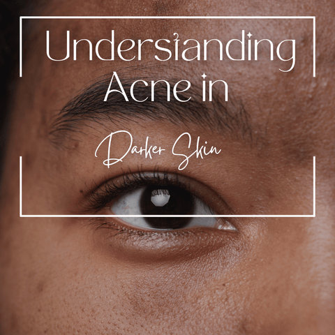 Understanding Acne in Darker Skin