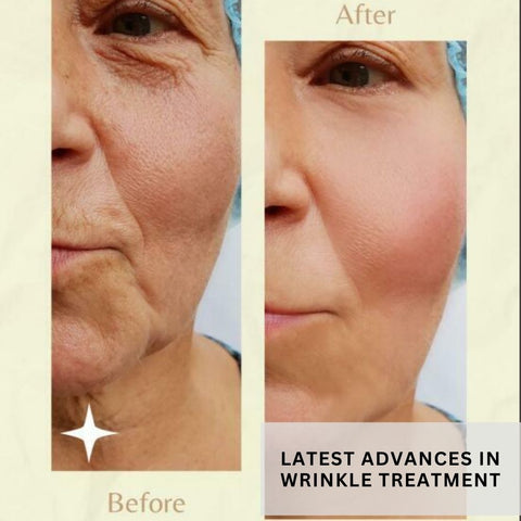 Latest Advances in Wrinkle Treatment