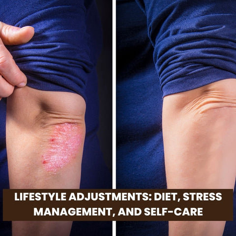 Lifestyle Adjustments: Diet, Stress Management, and Self-Care