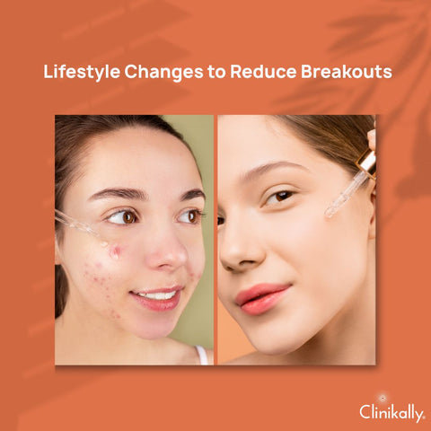 Lifestyle Changes to Reduce Breakouts