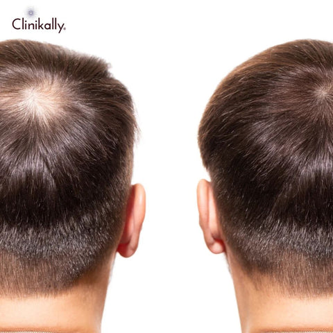 Managing Expectations: The Finasteride Results Timeline Explained