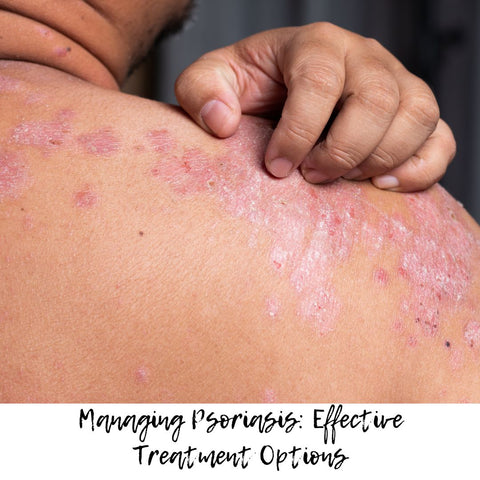 Managing Psoriasis: Effective Treatment Options