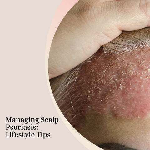 Managing Scalp Psoriasis: Lifestyle Tips