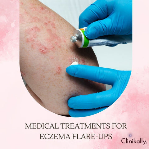 Medical Treatments for Eczema Flare-ups