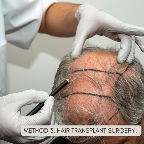 Method 3: Hair Transplant Surgery: Restoring Hair Permanently