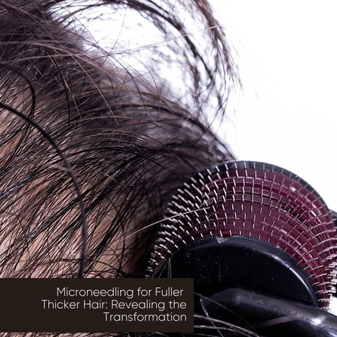 Microneedling for Fuller, Thicker Hair: Revealing the Transformation