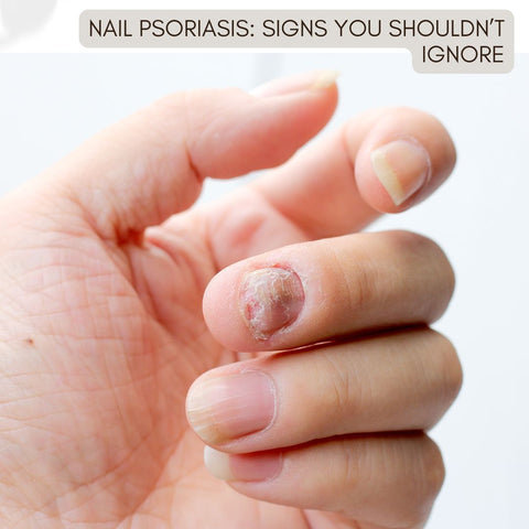 Nail Psoriasis: Signs You Shouldn’t Ignore