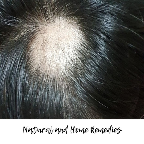 Natural and Home Remedies