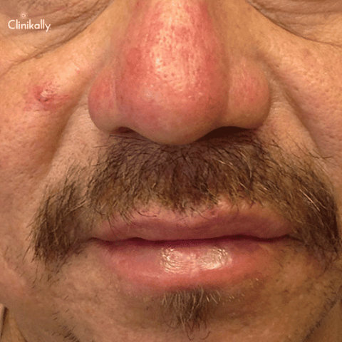 Rhinophyma (nose): Causes, 