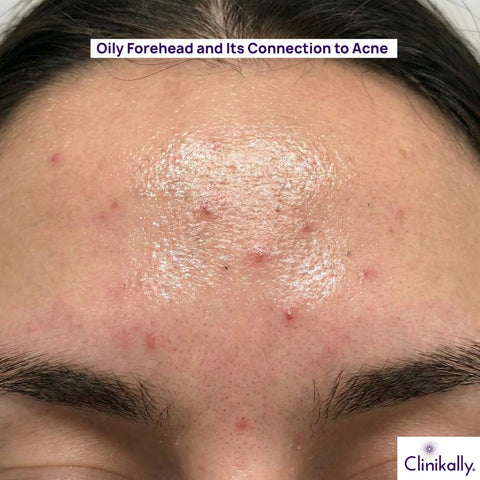 Oily Forehead and Its Connection to Acne