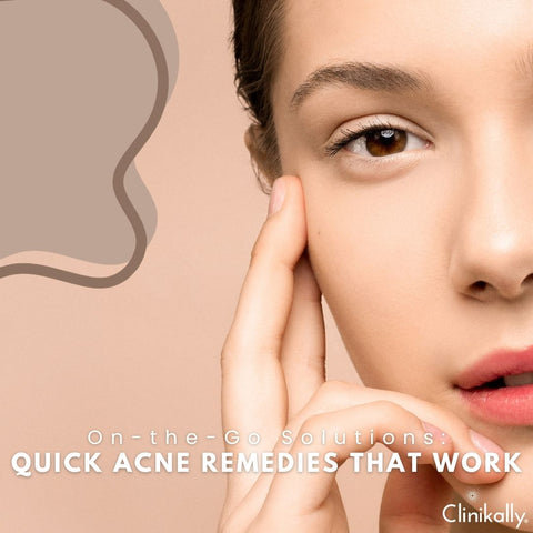 On-the-Go Solutions: Quick Acne Remedies That Work