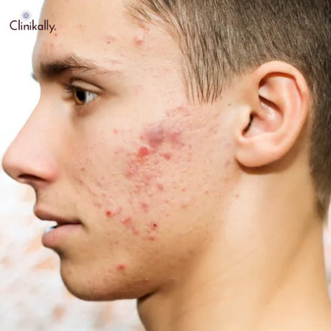 The Truth About Junk Food and Acne: Separating Fact from Fiction