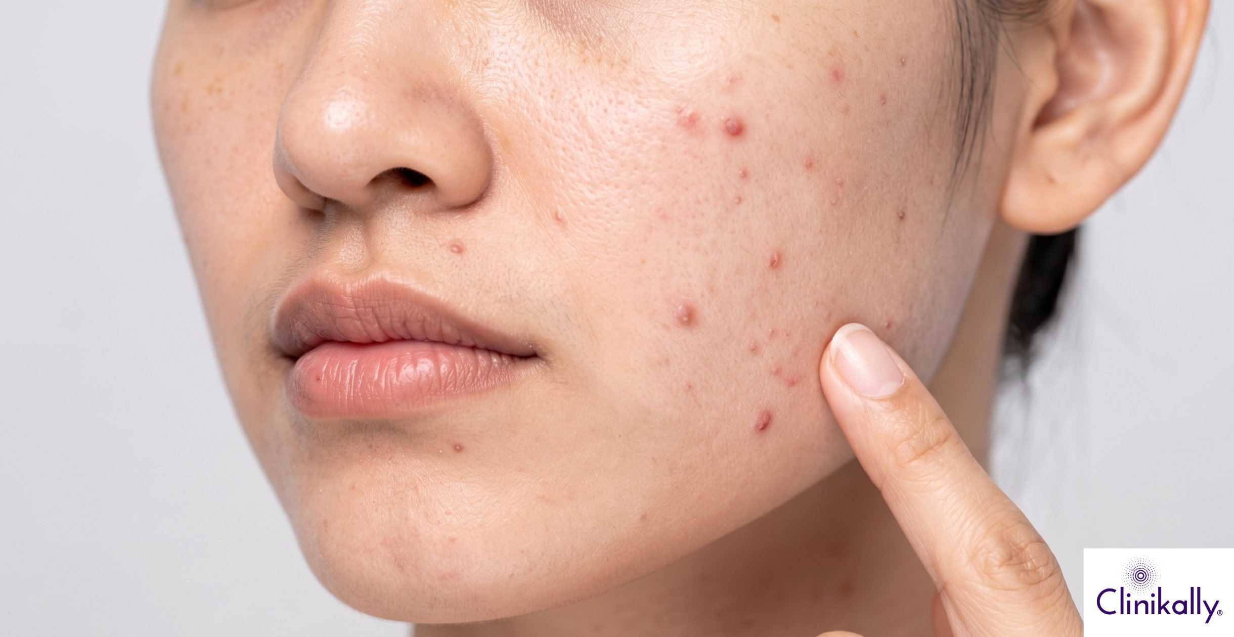 PMOS (PCOS) and Acne: Effective Tips for Clear Skin