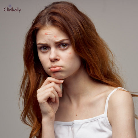 Hormonal Acne