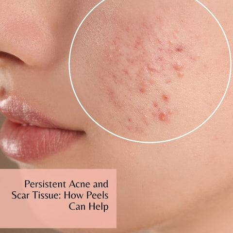 Persistent Acne and Scar Tissue: How Peels Can Help