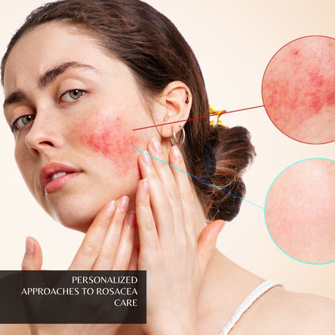 Personalized Approaches to Rosacea Care