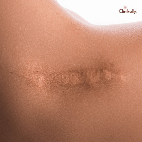 Piercing Bumps and Keloids