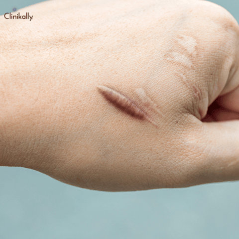 Piercing Bumps and Keloids